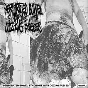 FLAC Perforated Bowel Syndrome With Oozing Faeces - Perforated Bowel Syndrome With Oozing Faeces