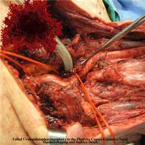 FLAC Acute Necrotizing Hepatic Tumours of the Paralyzed Liver - Failed Uvolopalatopharyngoplasty to the Pharynx Causes Extensive Nasal Haemorrhaging and Sudden Death
